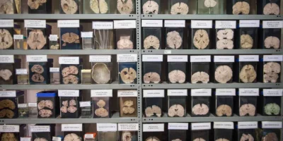 لماذا تحتفظ جامعة دانماركية بنحو 10 آلاف دماغ بشري في الفورمالين؟